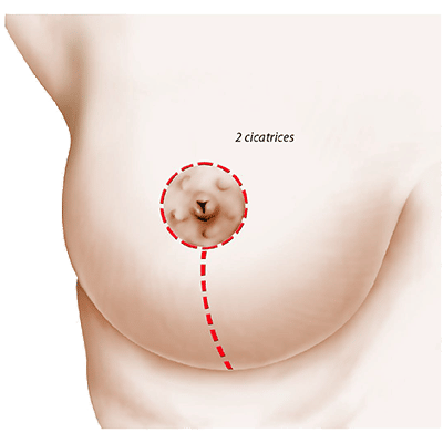 Lifting des seins grâce à la ptose mammaire à Rennes et en Bretagne