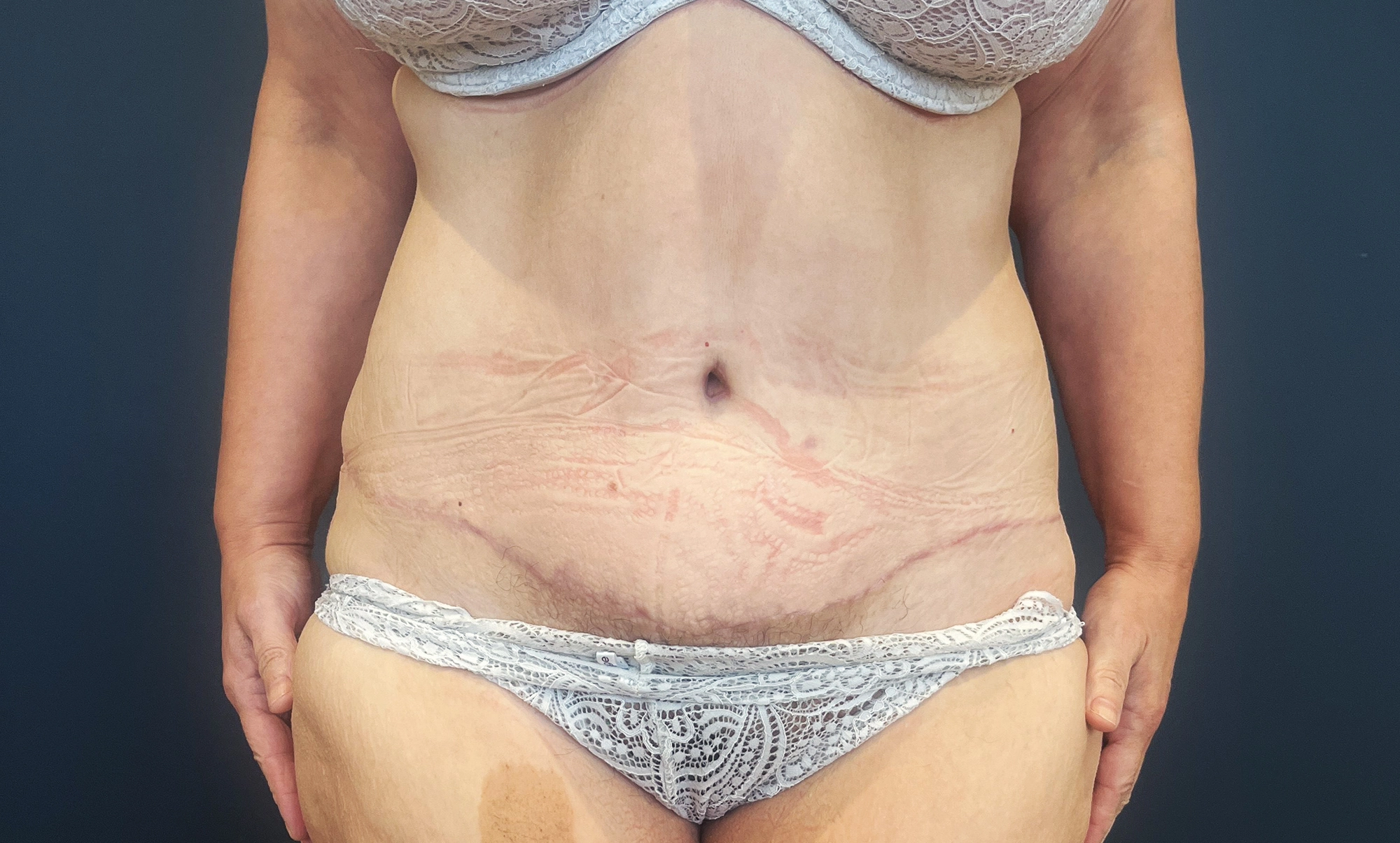 Chirurgie silhouette - abdominoplastie après à Rennes