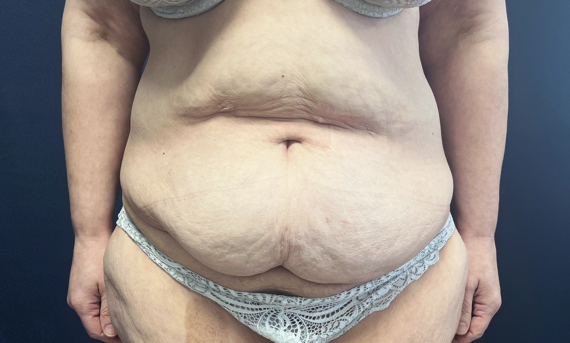 Chirurgie silhouette - abdominoplastie avant à Rennes