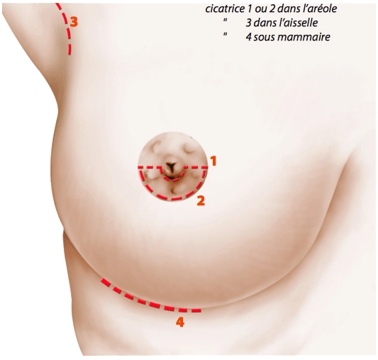 Les cicatrices suite à une augmentation mammaire à Rennes