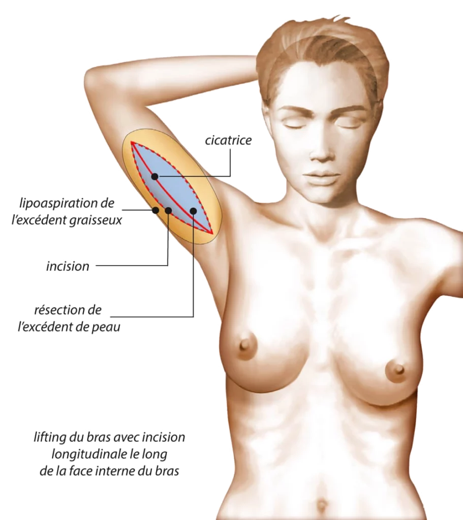 Les cicatrices suite à un lifting bras à Rennes