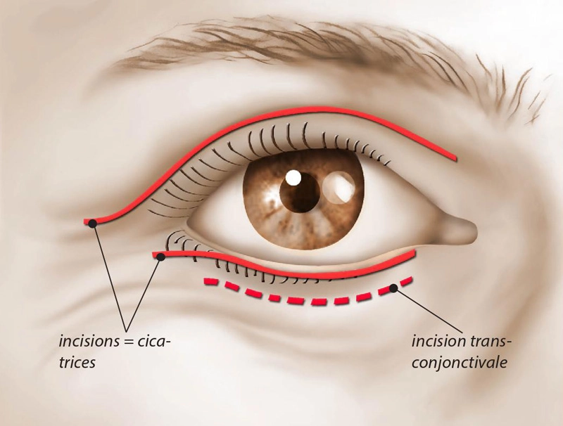 Les cicatrices après une blépharoplastie à Rennes