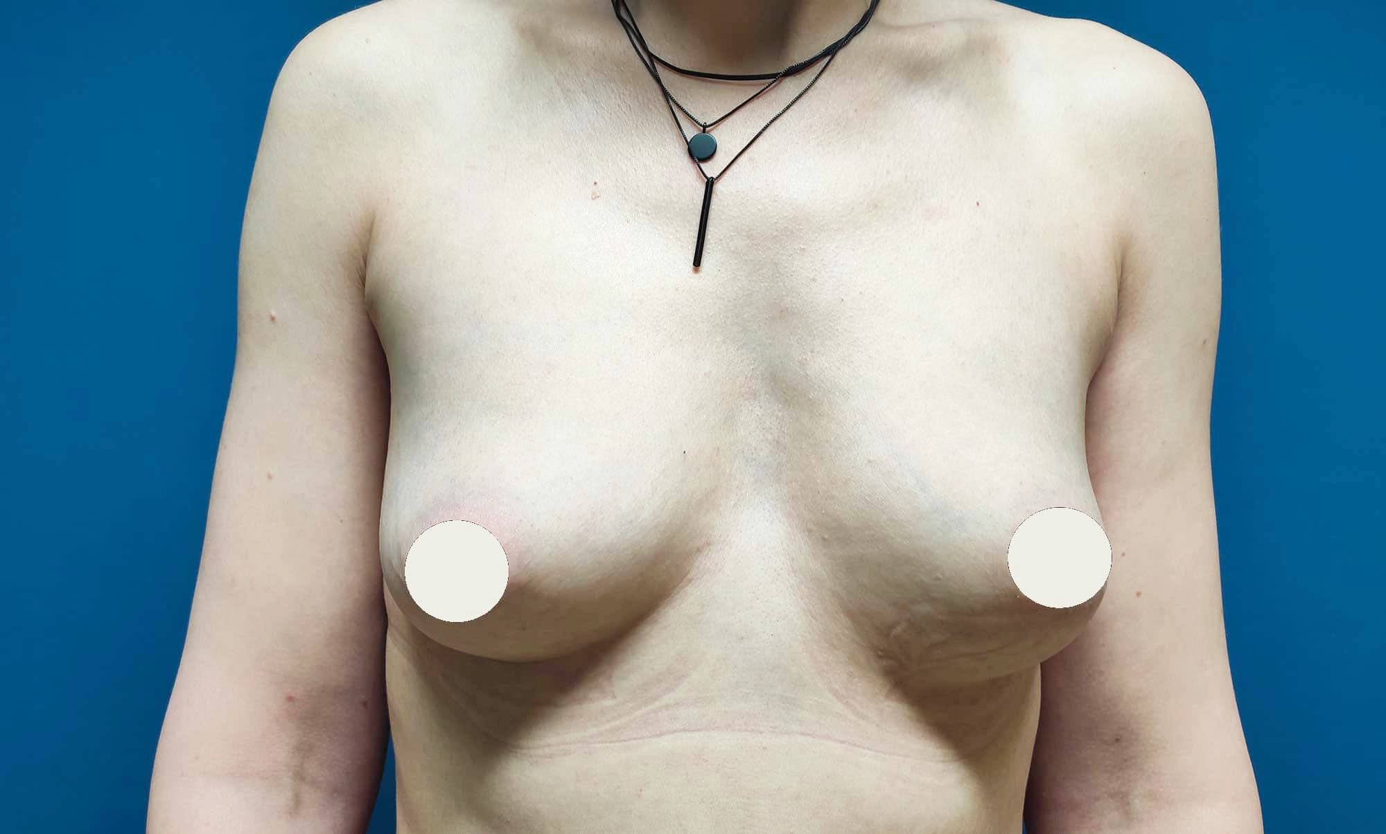 Chirurgie des seins à Rennes - lipolifting avant